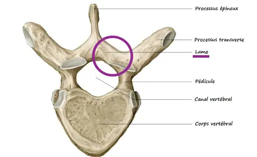 lame vertébrale retirée dans la laminectomie lombaire