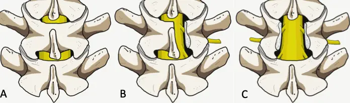 lumbal laminektomi
