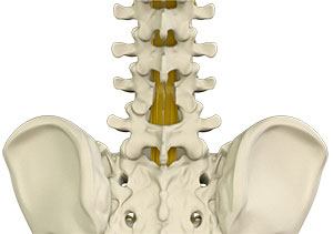 lumbal laminektomi L3-L4-L5