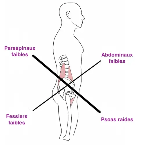 lower crossed syndrome lordose lombaire