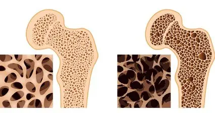ostéoporose de la hanche