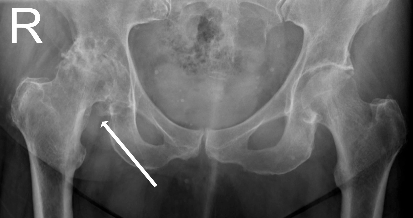 radiographie pour clarifier les douleurs à la hanche