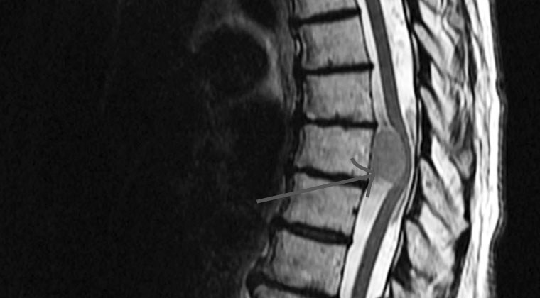 imaging to detect spinal cord cancer