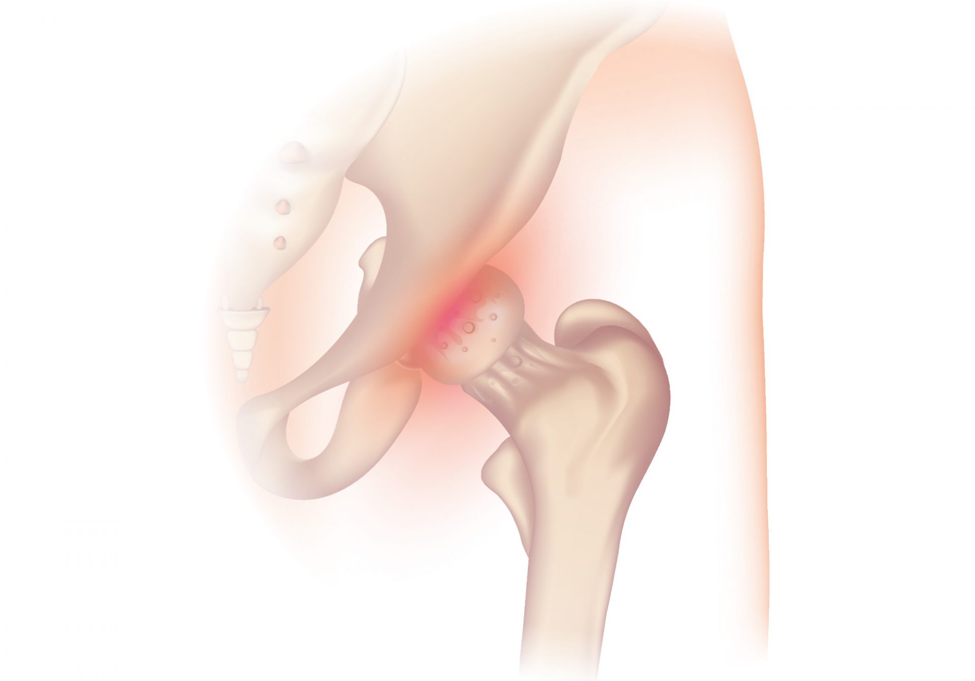 hip osteoarthritis requiring a hip prosthesis