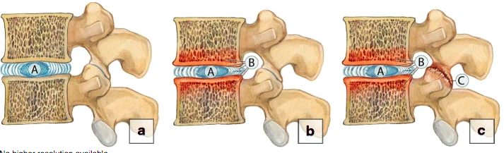 lumbale Arthritis
