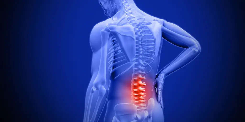 lumbar arthritis