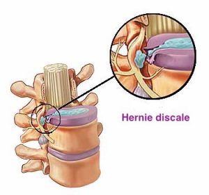 hérnia de disco cervical causando dor no pescoço