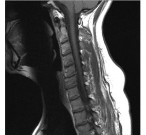 ressonància magnètica cervical