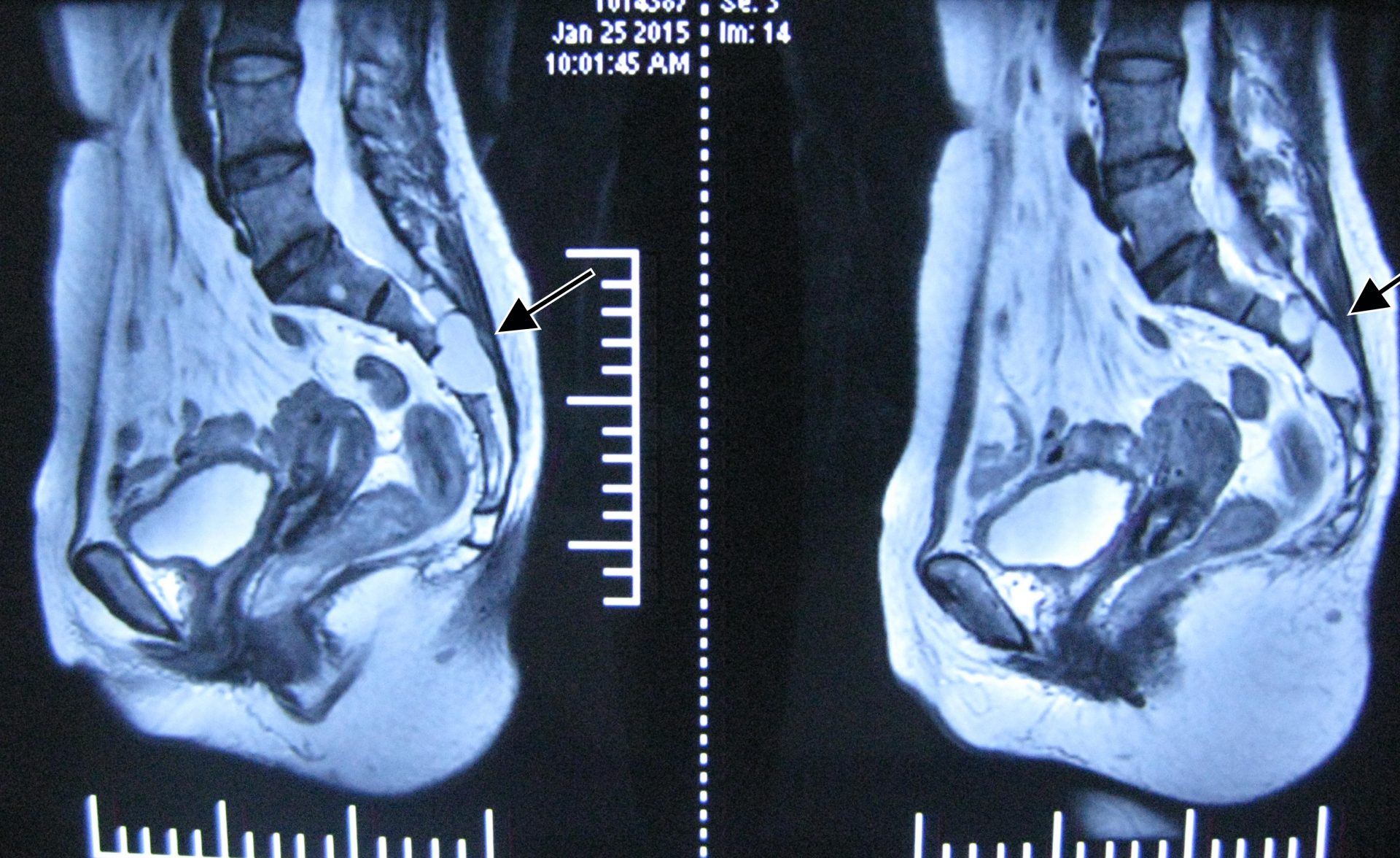 tarlov cyst