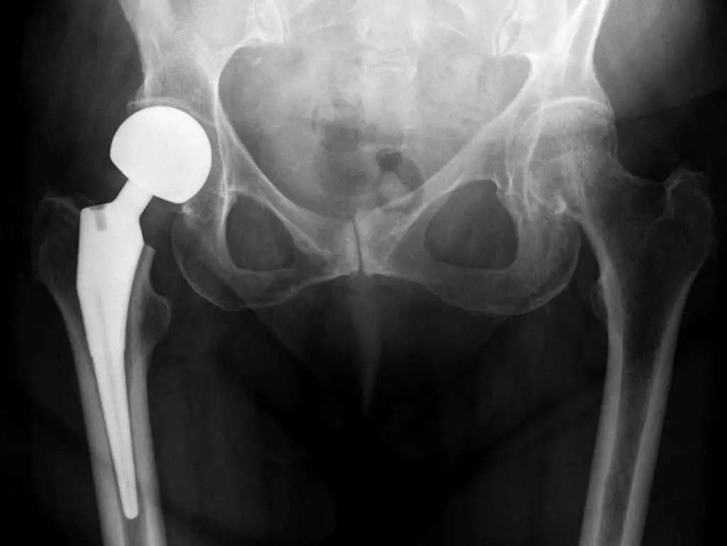 hip prosthesis