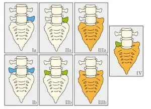 OIP lumbar sacralization