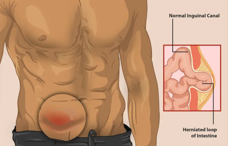 hernia inguinal