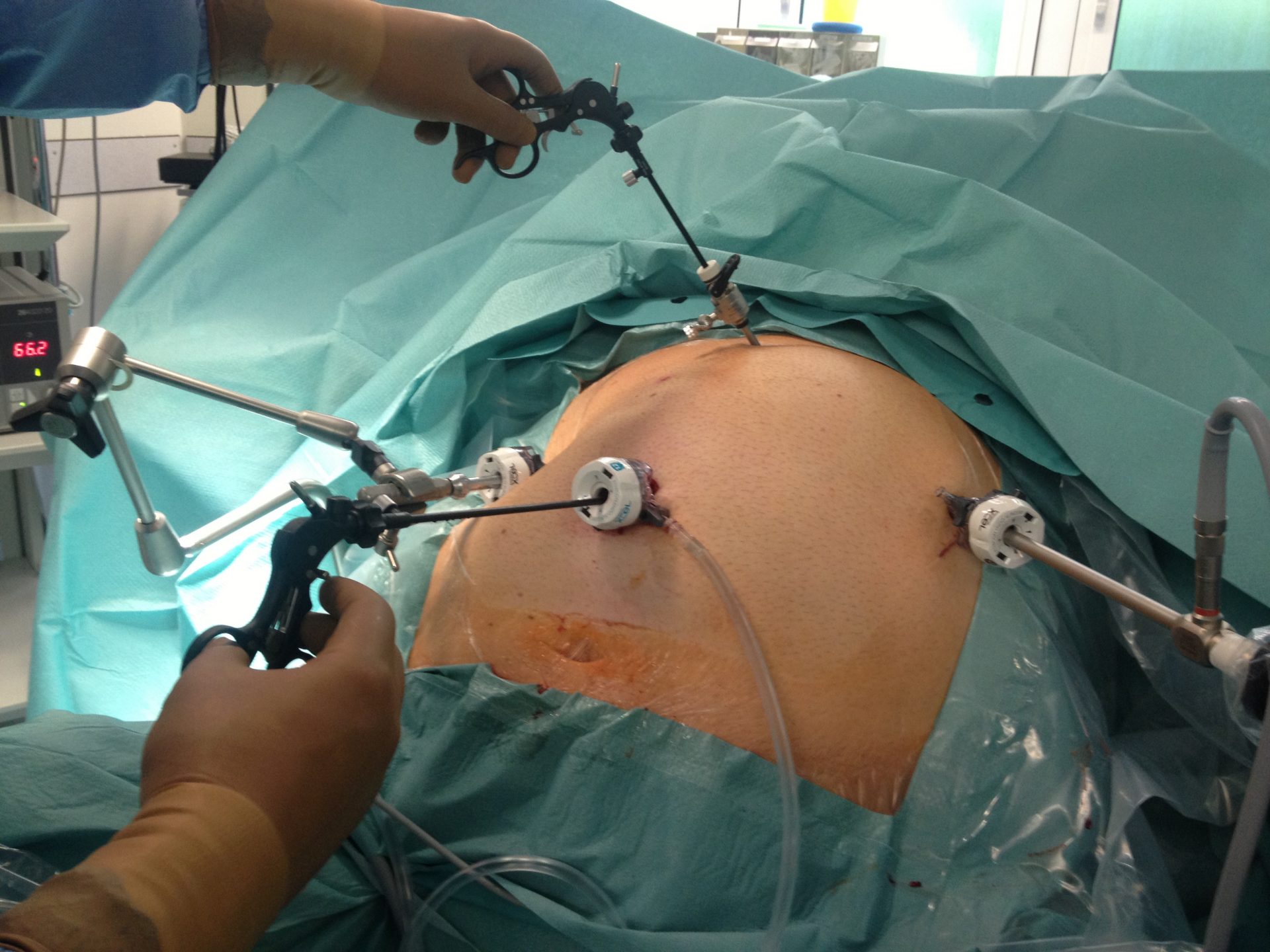 Fase quirúrgica de la cirurgia bariàtrica
