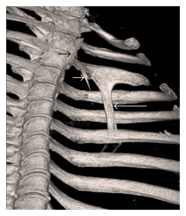 supernumerary rib