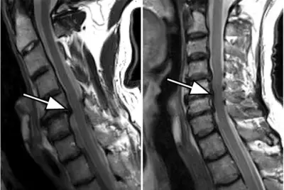 Nichttraumatische Kompression des Rückenmarks: Definition, Symptome, Prognose