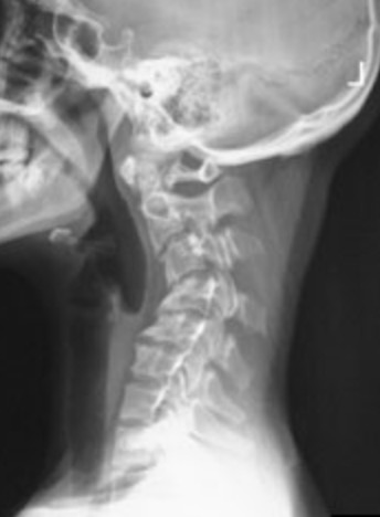 cervical kyphosis