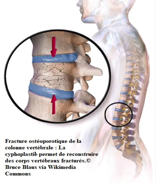 osteoporotisk fraktur