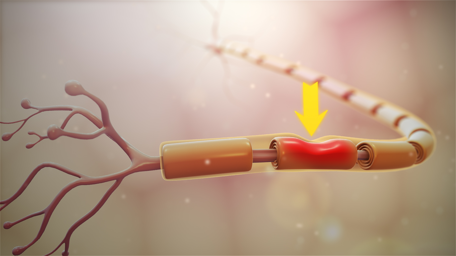 damage to the myelin sheath