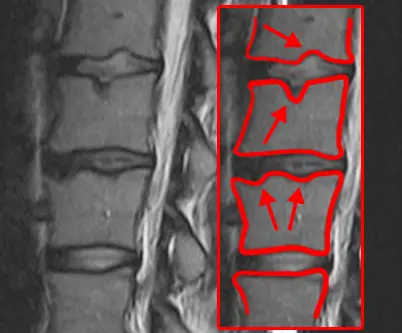 schmorl's hernia