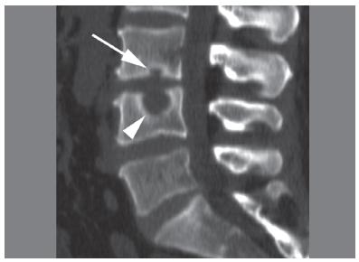 intraschwammiger Hernienschmorl