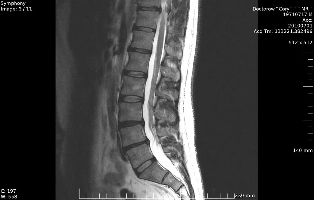 aftur mri