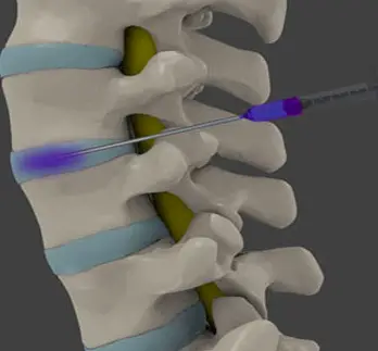 nukleolizna infiltracija bolečine v hrbtu