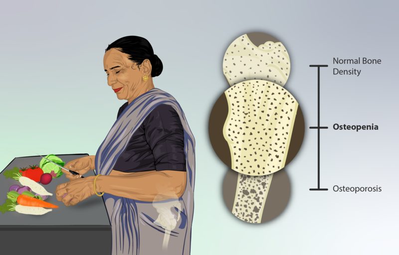 osteopeni