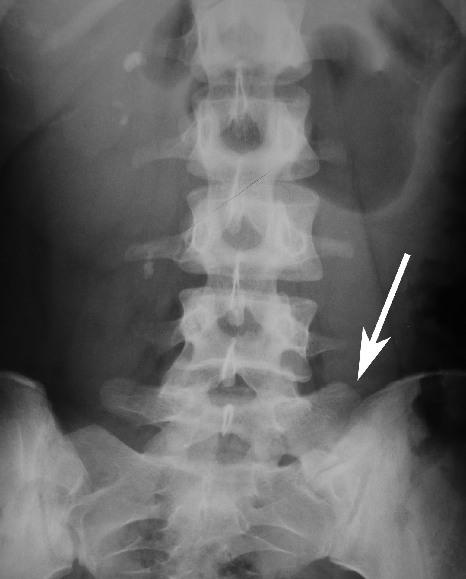 rentgenska slika, ki kaže sakralizacijo
