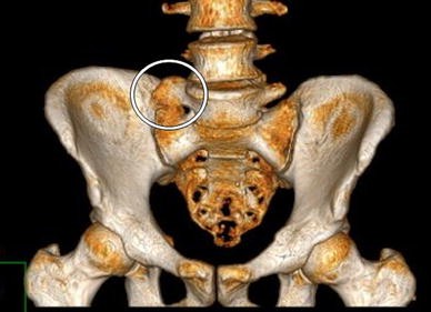 sacralización lumbar