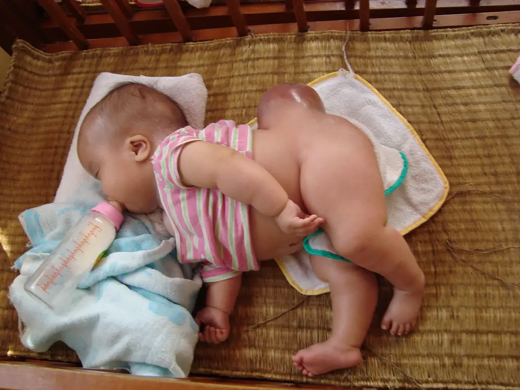 bebê com espinha bífida