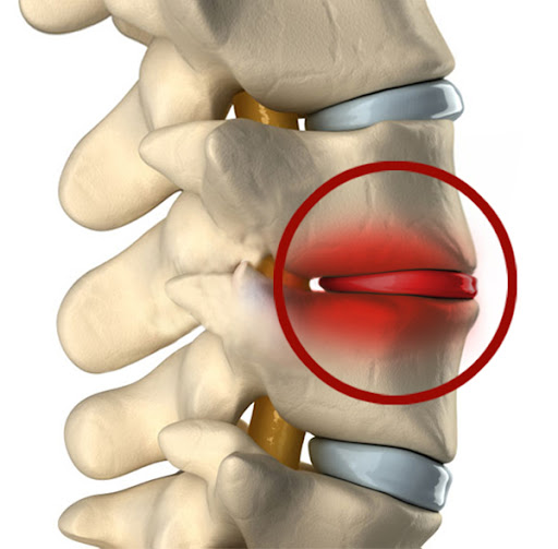 spondylodiscite