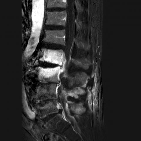 spondylodiscitis diagnosticeret ved MR