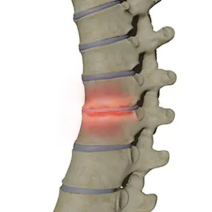 Spondylodiszitis