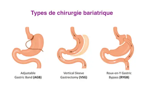 tipus de cirurgia bariàtrica