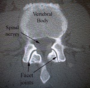 Facetter normal ct w tekst bedre kontrast zygapophyseal slidgigt