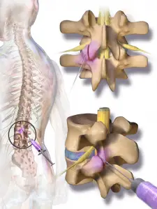 Great Blausen 0391 FacetJoint Zygapophyseal slidgigt injektion