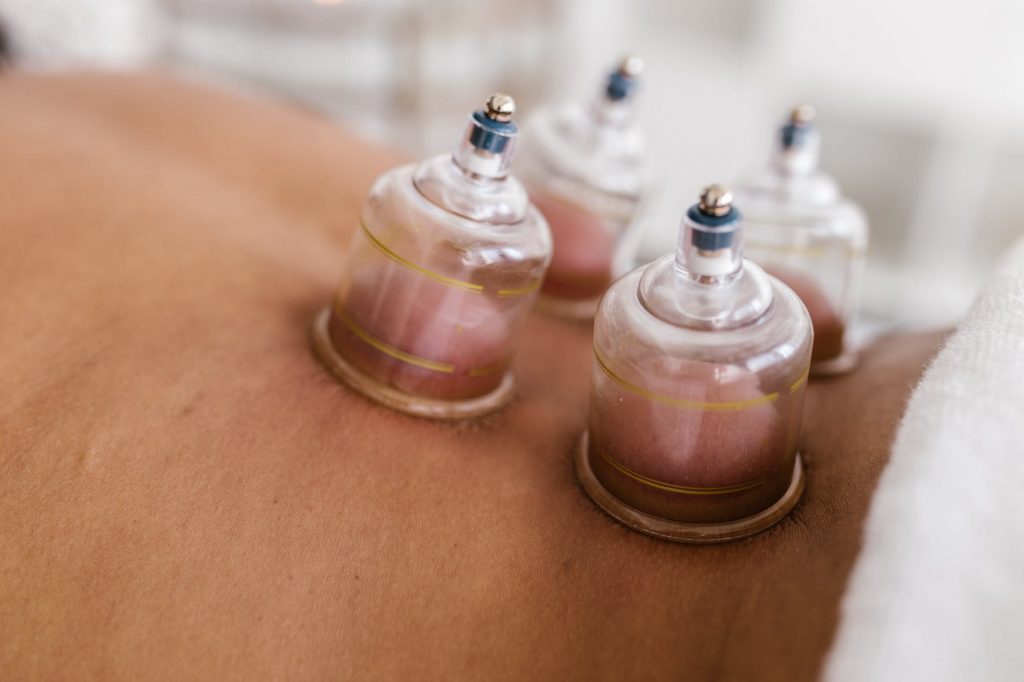 cupping therapy back pain chinese meaning