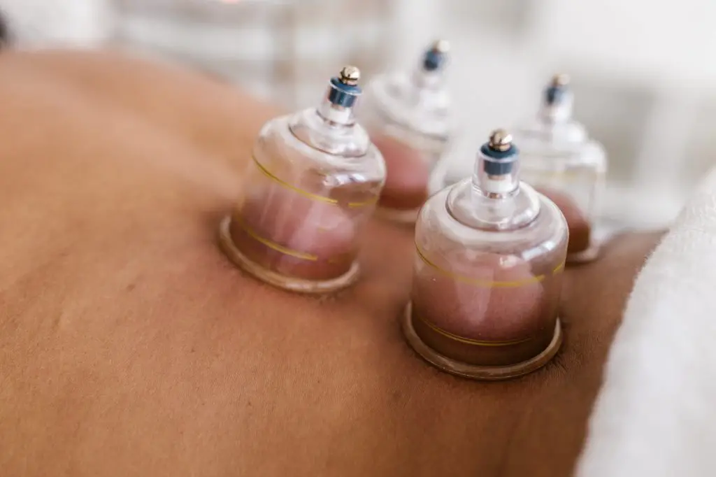 cupping therapie cupping therapie