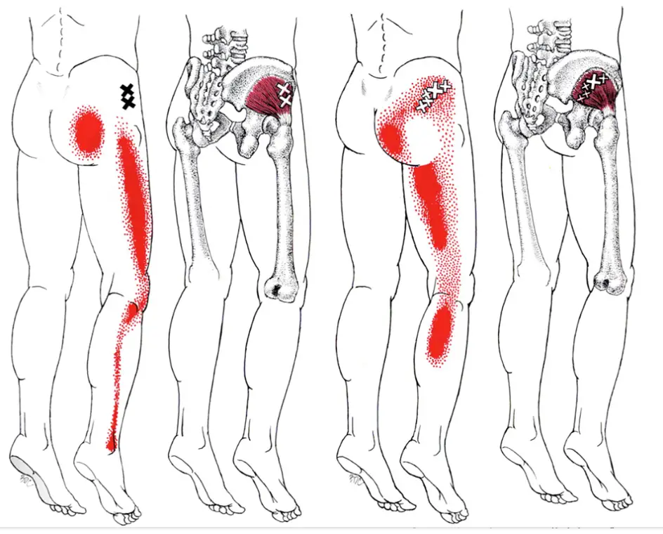 bestråling af smerte ved tilstedeværelse af gluteus medius senebetændelse