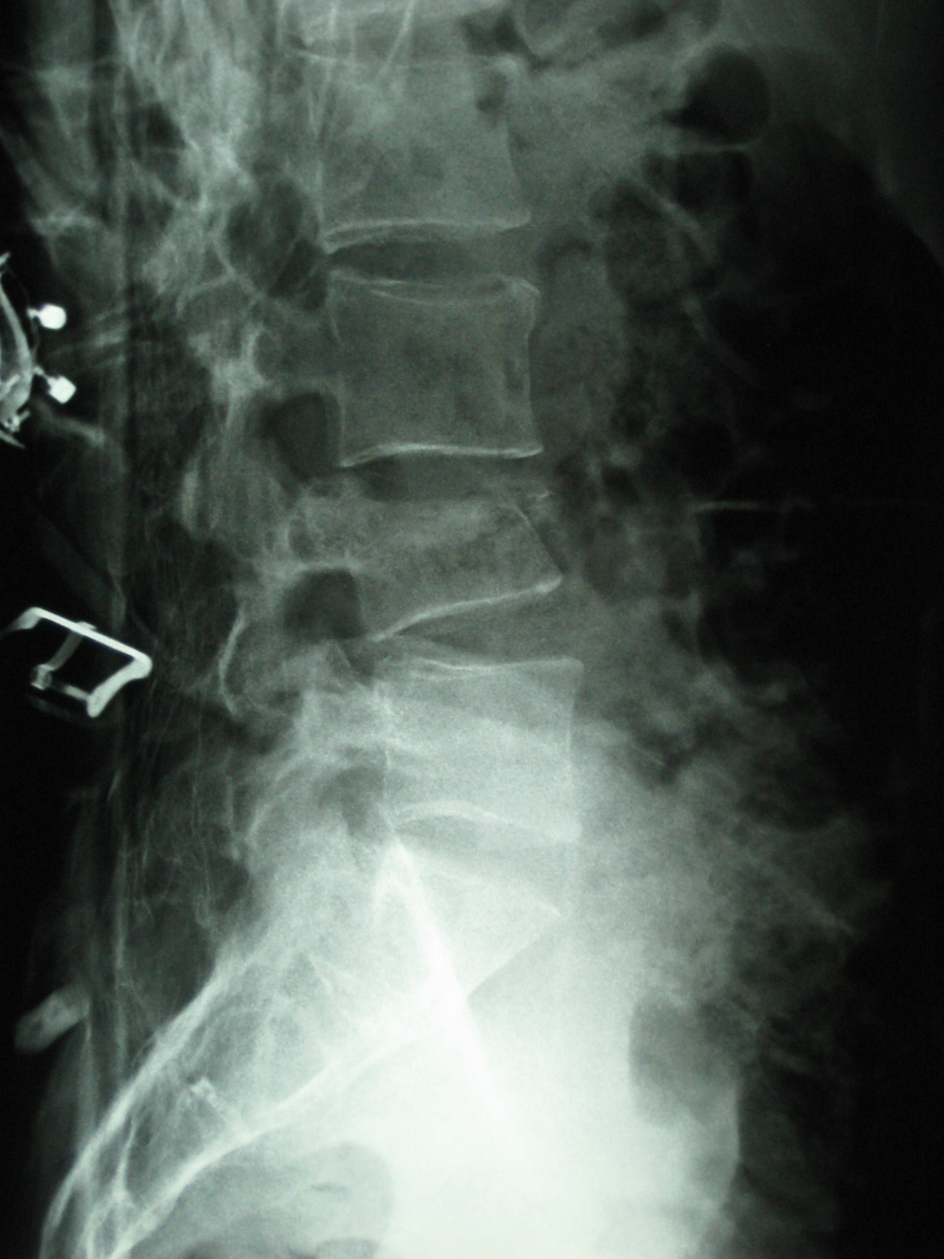 radiographie d'une fracture de la vertèbre