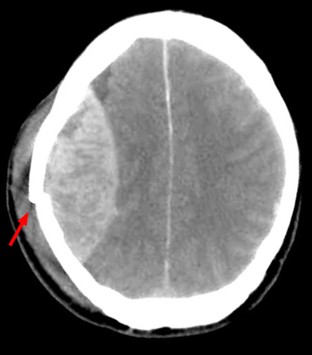 hematoma epidural