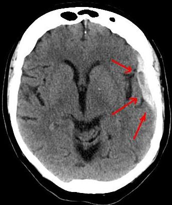 hématome sous-dural