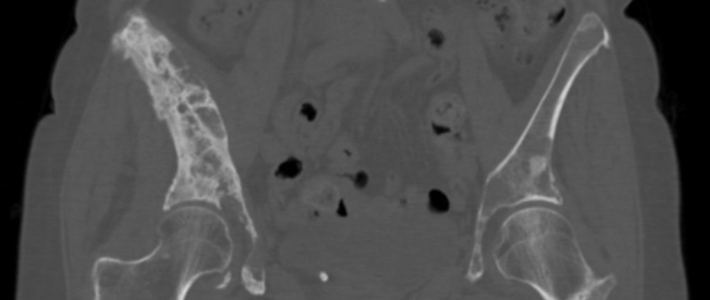 bone metastasis bone metastasis