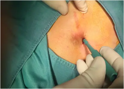 surgical removal of the sacrococcygeal cyst