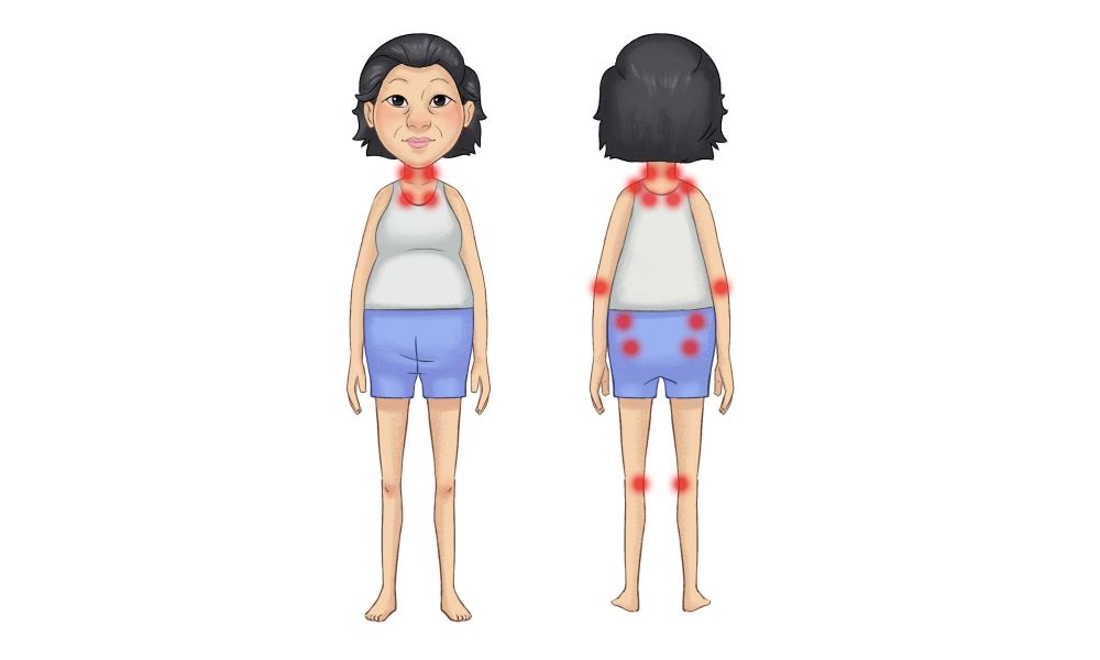 polymyalgia rheumatica