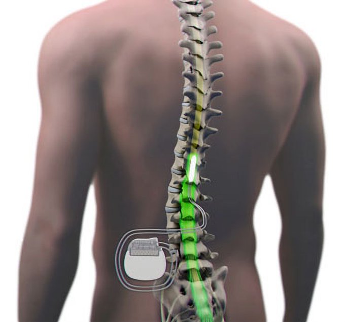 rygmarvsstimulering