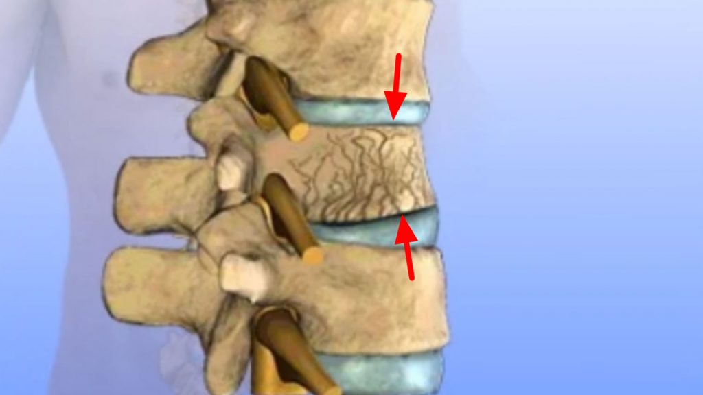 vertebral compression vertebral compression