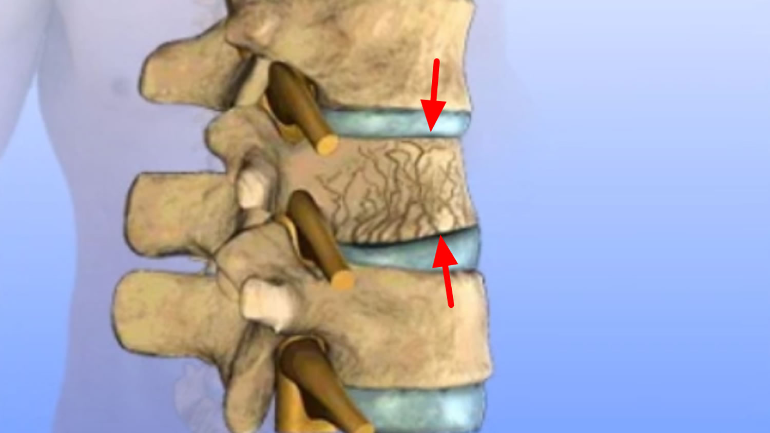 vertebral komprimering