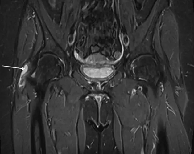 gluteus medius senebetændelse på MR