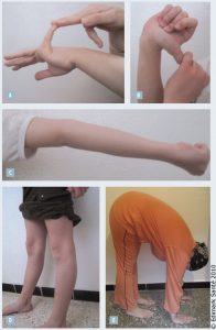 Beighton Ehlers-Danlos syndrom